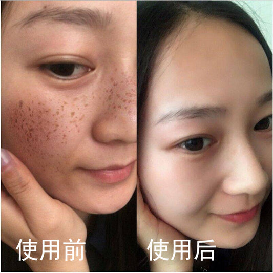 Pore Cleansing Peel Mask for Freckles, Dark Spots, Dullness Improvement, Whitening, Blackhead and Acne Removal, Peel-off Mask, Spot Absorbing Mask