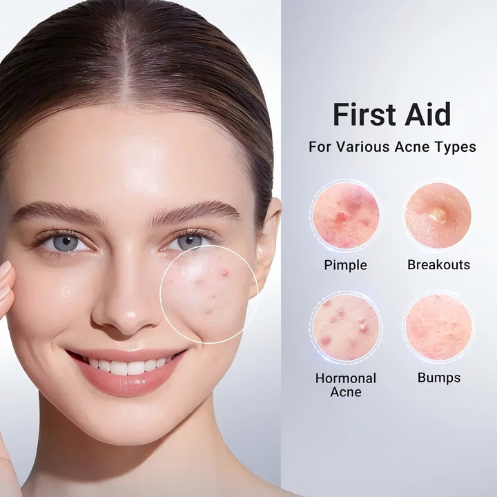 Acne Drying Lotion OEM