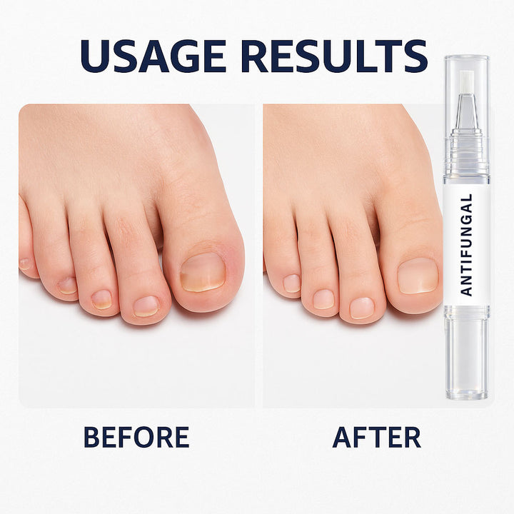 跨境指甲真菌笔3支装 4ml*3 日常修护手足直接护理精华